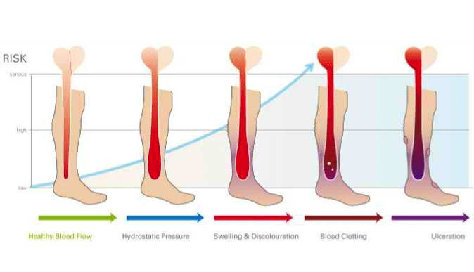 Herramientas de evaluación del riesgo de úlcera de pierna venosa