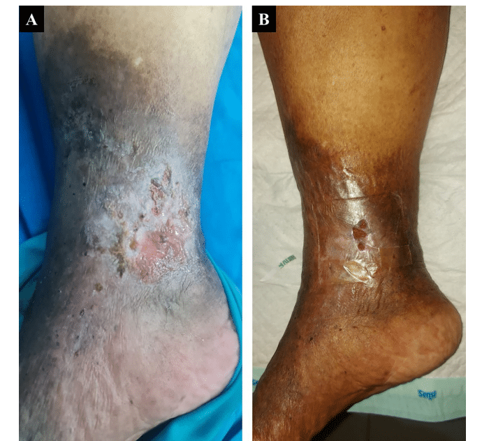 Satisfactory result of great saphenous vein endovenous laser ablation until below the knee on active venous leg ulcer: a case series.