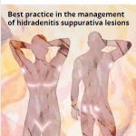 Best practice i in the management of hidradenitis suppurativa lesions